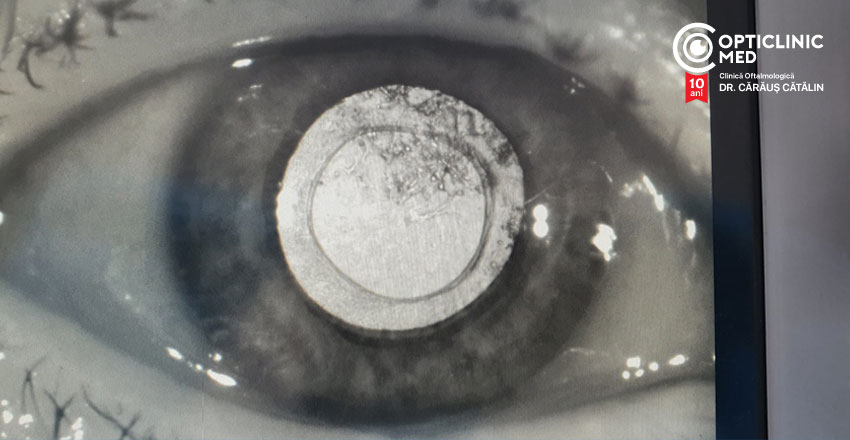 cataracta-secundara-operatie-opticlinicmed-caraus-catalin